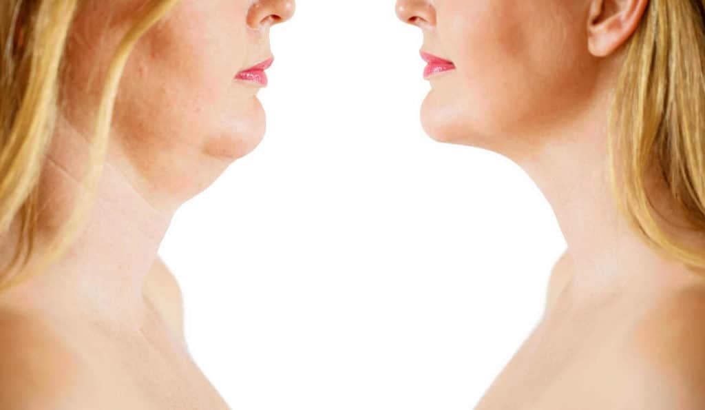 Double Chin treatment Walton-on-Thames before and after results