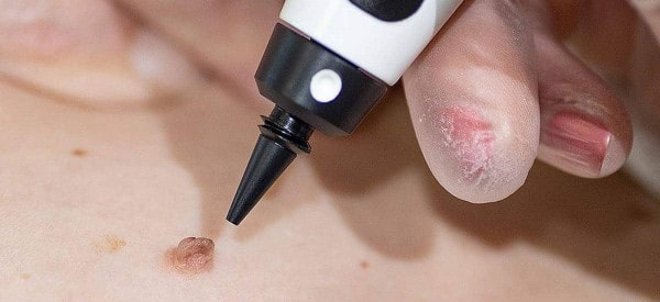 After Skin Tag Removal Walton-on-Thames