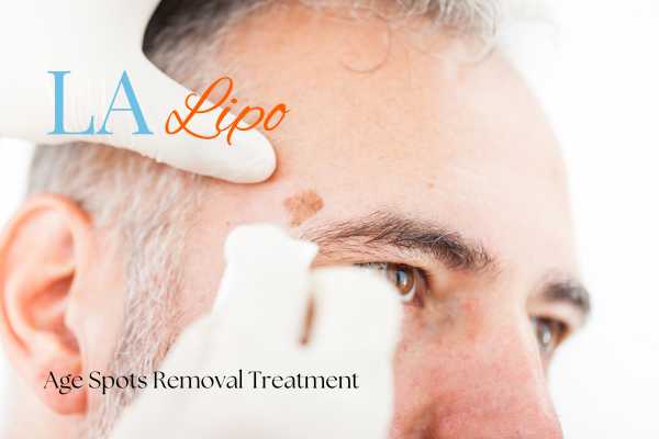 What Are the Most Effective Treatments for Age Spots Walton-on-Thames?
