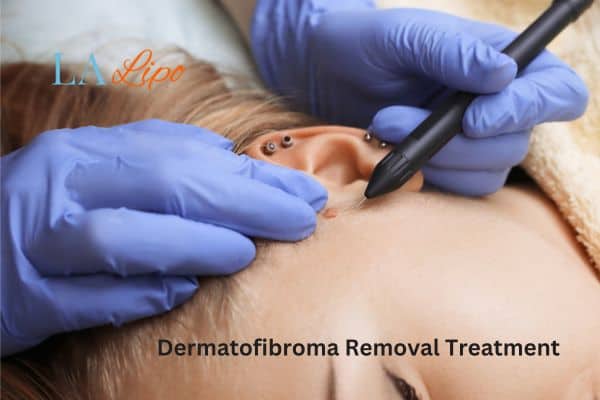 Dermatofibroma Removal Treatment Walton-on-Thames