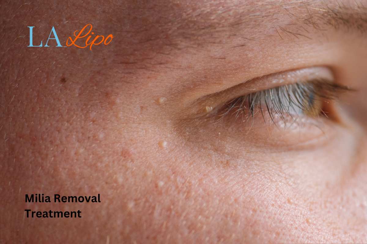 Cryopen Milia Removal: Is It the Easiest and Safest Option Walton-on-Thames?