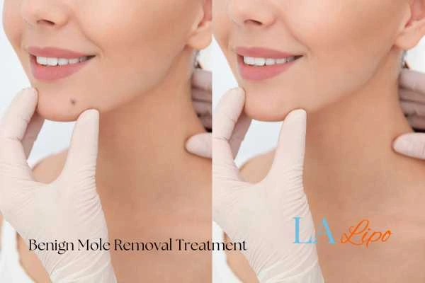 Before-and-after results following benign mole-removal treatment Walton-on-Thames