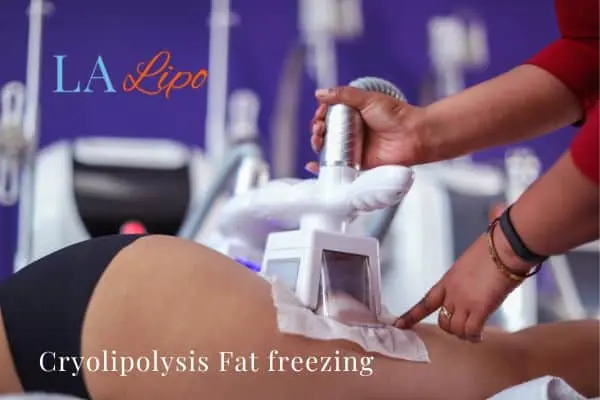women getting fat freezing Walton-on-Thames