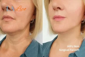 hi-fu for wrinkles Walton-on-Thames before and after results
