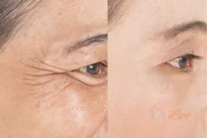 Before and after results of woman - HI-fu wrinkles reduction treatment Walton-on-Thames