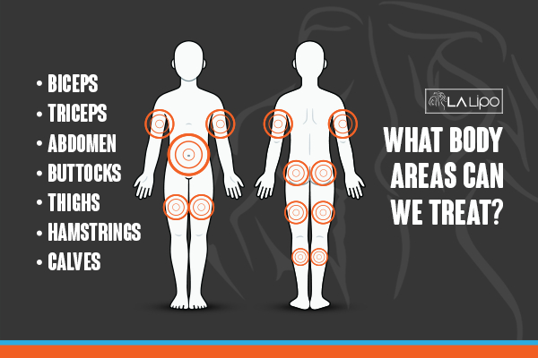 Graphic to show areas you can have LA-EMS Body Sculpting Walton-on-Thames treatment.