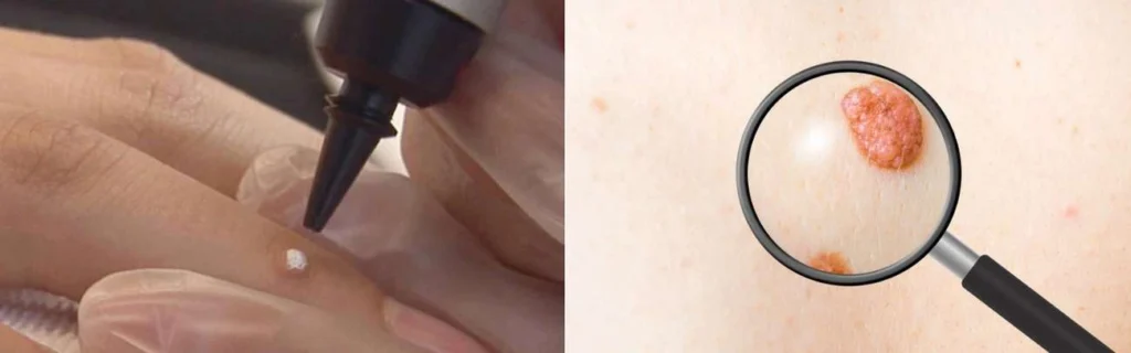 CryoPen practitioner Walton-on-Thames assessing a benign mole before treatment