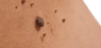 image of a skin tag Walton-on-Thames