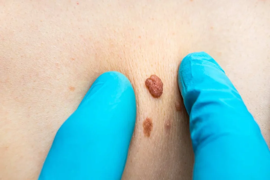 Consultant examining a skin tag Walton-on-Thames