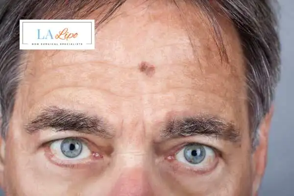 Solar Lentigo Removal Walton-on-Thames image of man with mark on his forehead