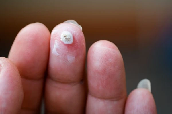 wart on person finger - cryotherapy to treat from LA LIPO Walton-on-Thames