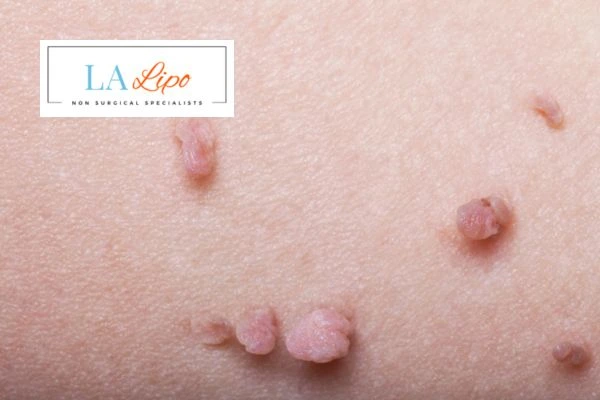 Does cryopen skin tag removal Walton-on-Thames hurt? Find out now call our team today!