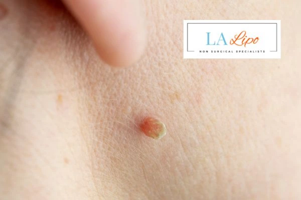 Book skin tag removal Walton-on-Thames today speak to our team now!