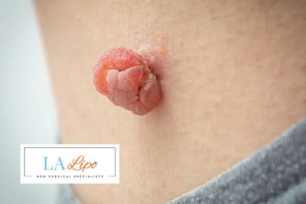 Interested in skin tag removal Walton-on-Thames? Concerned about the pain? Find out more today!