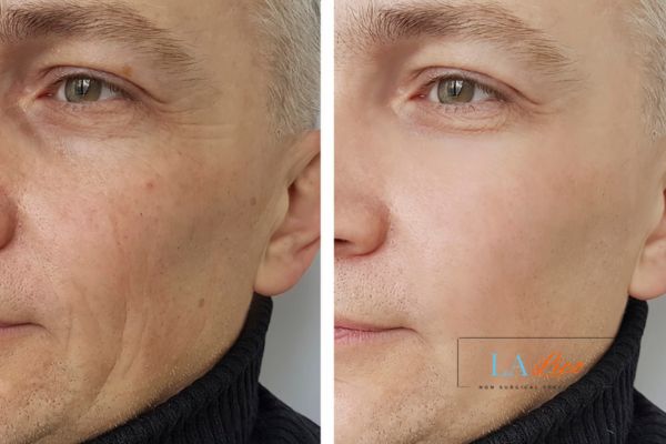 See the amazing results of Morpheus8 Treatment Walton-on-Thames!