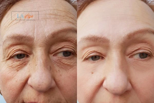 The powerful benefits of Morpheus8 Treatment Walton-on-Thames - Call Our team today!