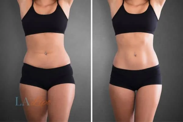 before and after results of non-surgical treatment to help a woman's body image and mental health Walton-on-Thames