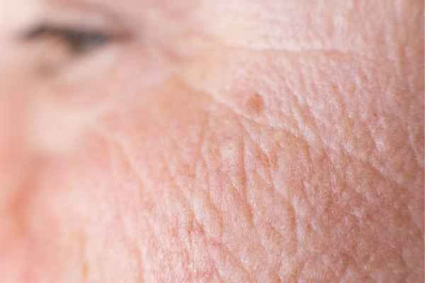 close up picture of a woman's face showing an age spot Walton-on-Thames