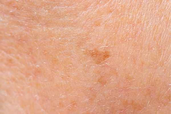 close up picture of age spots Walton-on-Thames