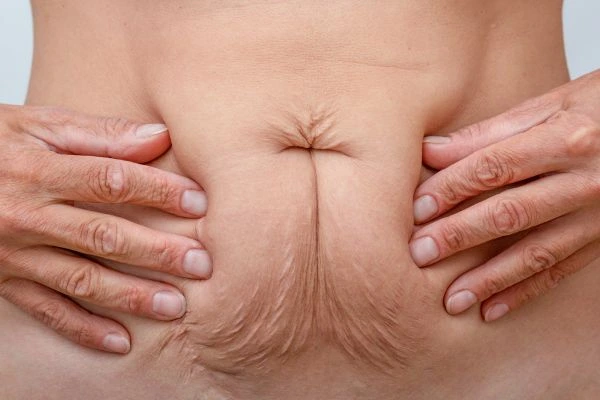 Image of a woman's stomach with loose skin - example of skin tightening Walton-on-Thames options