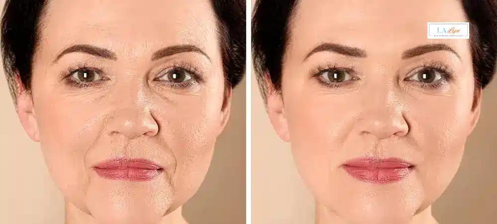 How Long Does It Take to See Results and How Long Do They Last Walton-on-Thames?