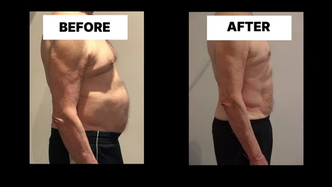 What Symptoms Can Diastasis Recti Cause in Men? Weak Core, Back Pain and Poor Posture Walton-on-Thames